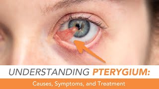 Understanding Pterygium Eye Growth [upl. by Inman]