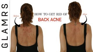 How To Get Rid of Back Acne the Natural Way  Effective Home Remedies [upl. by Wendie]