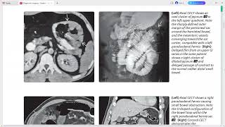 Peritoneum mesentery and abdominal wall imaging [upl. by Gussi23]