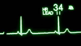 Sinus Bradycardia [upl. by Ferrell668]