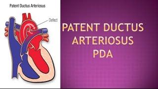 Patent ductus arteriosusPDAheart disorder [upl. by Connie]