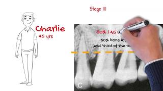 The new periodontal classification MUST WATCH FOR ALL DENTISTS [upl. by Eimaral]