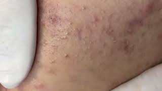 Blackheads amp Whiteheads Removal New On Cheek 2024 Acne Treatment With Nhat Bang [upl. by Atidnan]