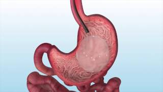 Orbera Intragastric Balloon Patient Animation [upl. by Arretak309]