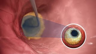 Debulking calcium with Hawkone™ directional atherectomy [upl. by Eastman595]