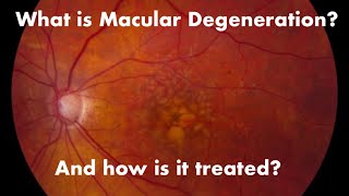 What is Macular Degeneration and how is it treated  The Eye Surgeon [upl. by Nellek]