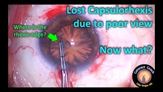 Lost Capsulorhexis during Cataract Surgery  here is how to fix this problem [upl. by Mulligan]