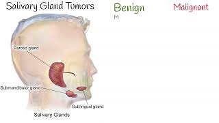 Salivary Gland Tumors Salivary gland cancers and benign tumors [upl. by Eerej180]