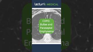 🔍 CT Scan Insights Bullae amp Paraseptal Emphysema EmphysemaInsights RadiologyRevealed usmle [upl. by Faust]