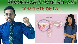 HEMORRHAGIC OVARIAN CYST Treatment [upl. by Ssilb970]