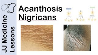 Acanthosis Nigricans  Risks Pathogenesis and Treatments [upl. by Meeharbi]