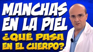 MANCHAS EN LA PIEL  ¿Qué pasa dentro del cuerpo de las personas que las padecen [upl. by Nedroj]