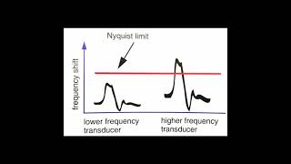 Aliasing Ultrasound Physics [upl. by Thinia]