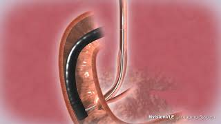 NvisionVLE Imaging System Biliary Animation [upl. by Aigneis289]