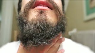 Patchy Beard Growth After 1 YEAR [upl. by Eaves472]