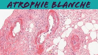 Atrophie blanche livedoid vasculopathy dermatology dermpath pathology [upl. by Nivram]