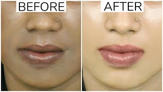 MAGICAL REMEDY to Remove BLACK PATCHES DARK SPOT ACNE SCARS HyperPigmentation  Anaysa [upl. by Dionne]