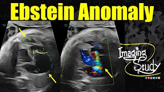 Ebstein Anomaly  Ultrasound  Fetal Echo  Case 345 [upl. by Bogart]