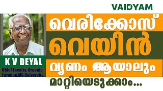 വെരിക്കോസ് വെയിൻ വൃണം ആയാലും മാറ്റിയെടുക്കാം NaturalAyurvedic Treatment Varicose Veins kvdayal [upl. by Rother574]