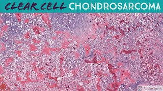 Clear Cell Chondrosarcoma [upl. by Isied23]