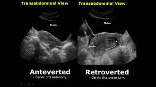 Uterine Positions In Ultrasound  AntevertedRetroverted  AnteflexedRetroflexed Uterus [upl. by Aslehc]