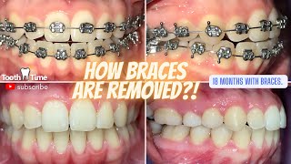 How Braces Are Removed  Open Bite Fixed 18 months Tooth Time Family Dentistry New Braunfels Texas [upl. by Sacci341]