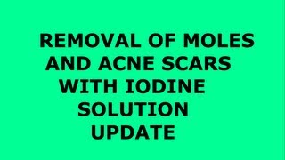 Update Removing Moles With Iodine Lugols Solution Tutorial [upl. by Nnylsor]