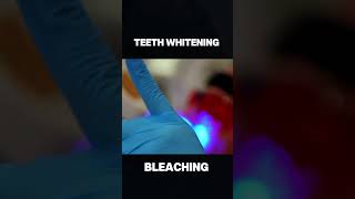 Teeth whitening Procedure teethwhitening shorts [upl. by Yarvis]