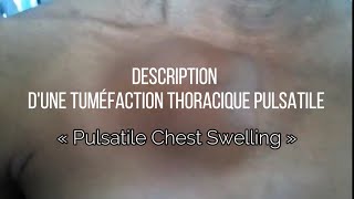 Description de la Tuméfaction thoracique pulsatile « Pulsatile chest swelling » [upl. by Fabrin]