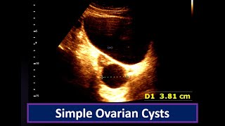 Understanding Simple Ovarian Cysts Ultrasound Findings  Ovarian Cyst  Simple follicular cyst [upl. by Golda]