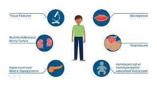 Introduction to BeckwithWiedemann Syndrome BWS [upl. by Anaugal779]