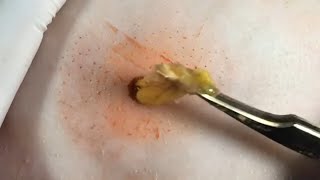 BEST Pimple Popping  Big Cystic Acne Blackheads  Whiteheads Removal  Blackhead Removal  VL072 [upl. by Aicilyt]