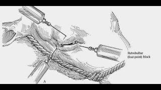 Retrobulbar nerve block in cattle 🐄 🐂 Peterson and four points block 🐄 🐂 [upl. by Cence]