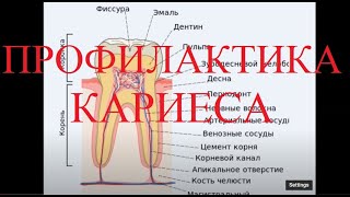 Кариес зубов  причины появления Как предотвратить появление кариеса [upl. by Brendis31]