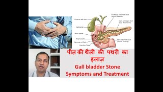 Gall bladder stone symptoms treatment in Hindi By Dr Vikas Singla [upl. by Yessak497]