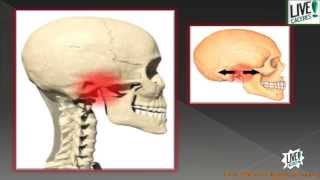 ¿Qué es el síndrome de disfunción temporomandibular ATM [upl. by Shanie]