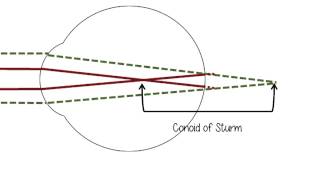 Conoid of Sturm  Circle of Least Confusion  Spherical Equivalent [upl. by Granthem]