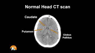 Normal Head CT Scan Anatomy Made Simple Neuroradiology [upl. by Rexferd22]