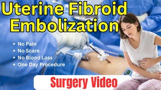 Uterine Fibroid Embolization  Surgery Video [upl. by Yorgerg752]