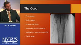 Single Session Thrombectomy vs CDT for ALI How do I Choose Bryan Fisher Session III Acute Limb Is [upl. by Groh]