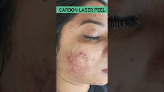 FASTEST ACNE RESULTSCARBON LASER PEEL DrArifMDDermatologist ACNE carbonpeel [upl. by Polak551]