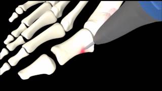 Operatie Hallux Valgus scheefstand grote teen via minimale invasieve correctie [upl. by Arlana627]