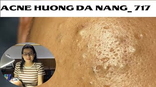 Acne Treatment Huong Da Nang 717  Remove Blackheads [upl. by Fine747]