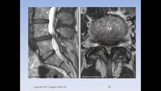 Lumbar Spinal Stenosis Cauda Equina Syndrome Sciatica amp Disc Herniation An Advanced Lecture [upl. by Benni11]