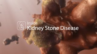 Medical Animation Kidney Stone Disease [upl. by Aisela]