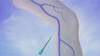 Part 4 Thermal Ablation Diagnosis and Treatment of Varicose Veins [upl. by Vinia]