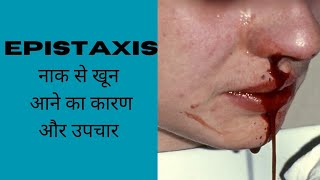 नाक से खून आने पर क्या करे  Nosebleed  Epistaxis treatment in hindi [upl. by Judd]