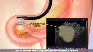 Endoscopic Ultrasound [upl. by Aleahpar]