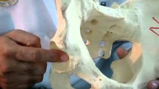 Salter’s innominate Osteotomy in Developemental Dysplastic Hip on Saw Bone Model [upl. by Annaillil]