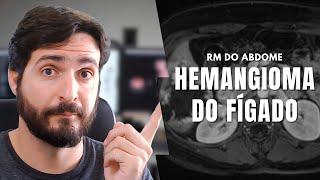 Hemangioma do fígado o nódulo mais comum na RM do abdome superior  Galvani Filho [upl. by Haraz358]